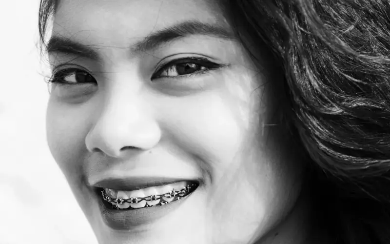 Appareil dentaire invisible, avantages et inconvénients que votre orthodontiste ne détaille pas toujours