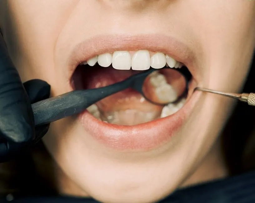 Comment prévenir les caries naturellement et efficacement ?
