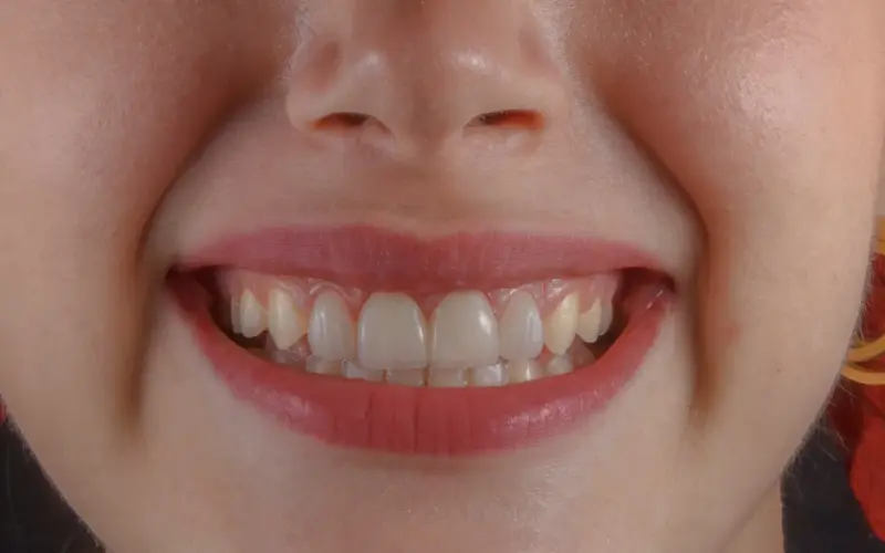 Correction de l'occlusion dentaire par orthodontie, ce que cela implique vraiment