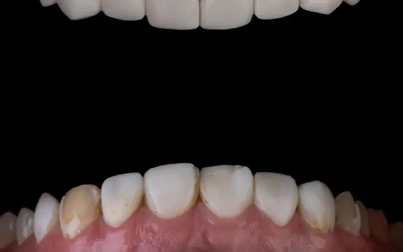 Non, le détartrage ne fragilise pas vos dents : idées reçues et réalité sur les risques et bénéfices pour la santé
