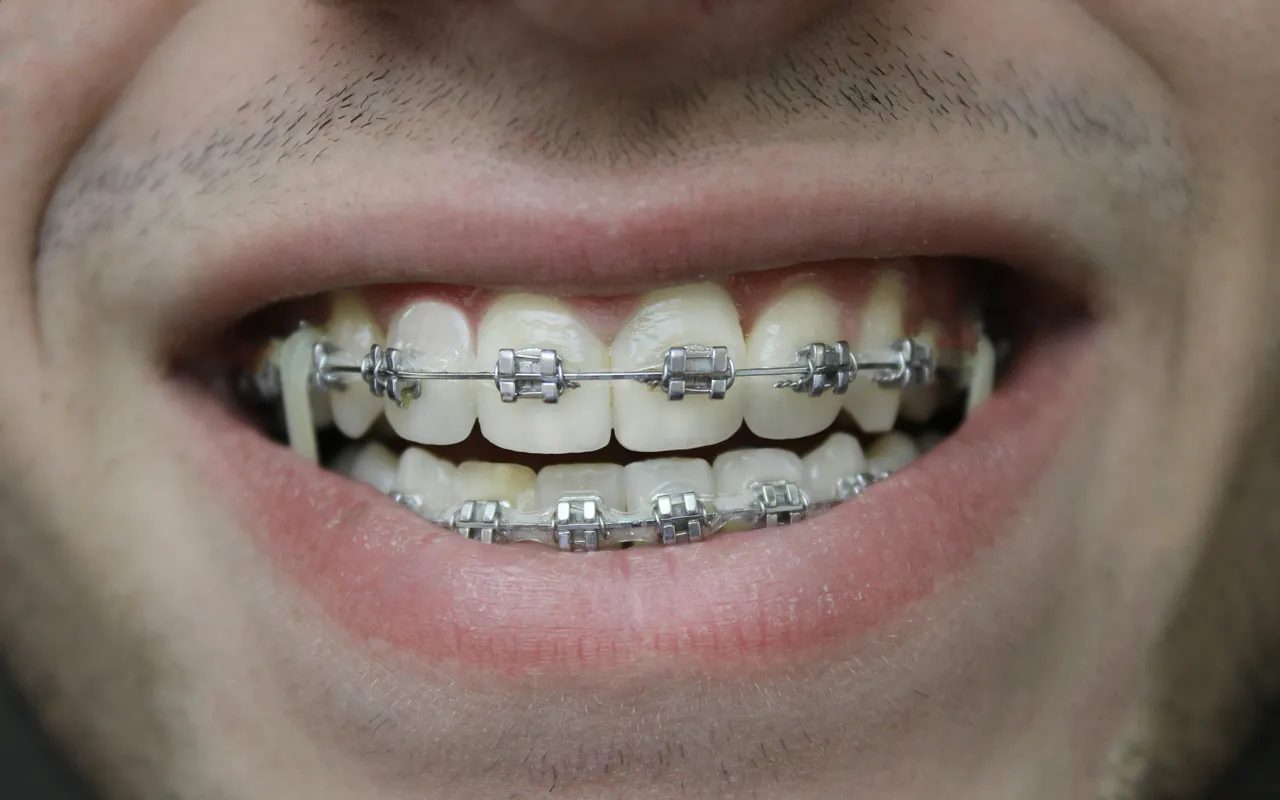 Vous portez un appareil dentaire et vous avez des migraines : y a-t-il vraiment un lien — Le mauvais alignement des dents est-il toujours en cause ?