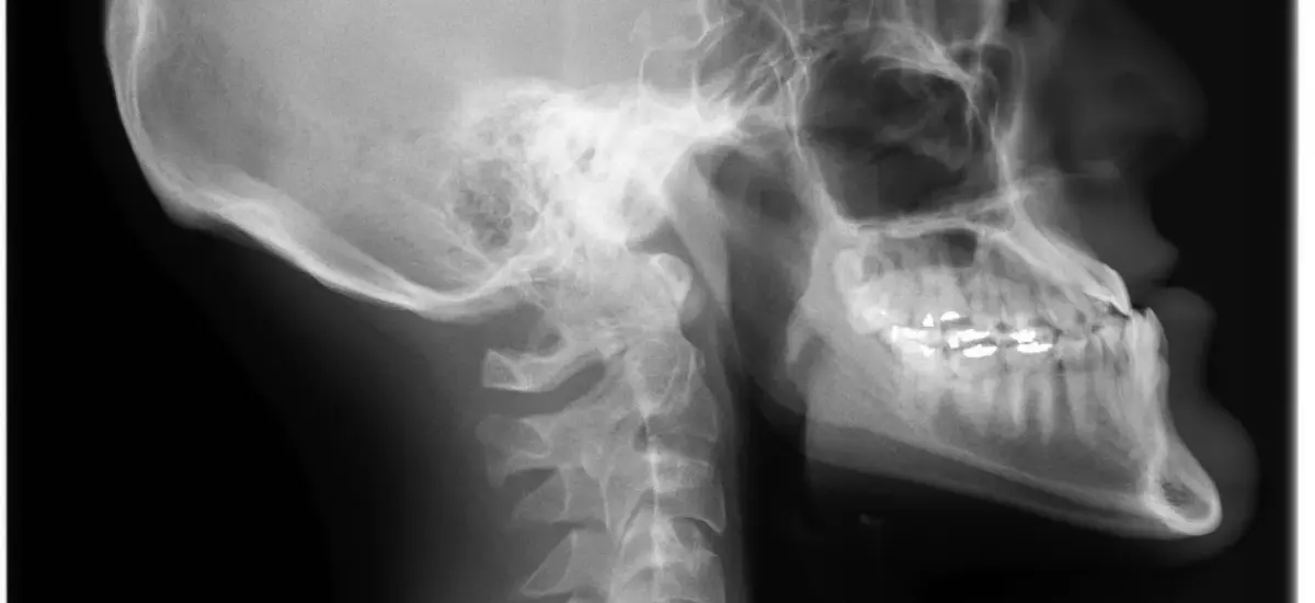 La malocclusion dentaire pèse sur la santé bien plus qu'on ne le croit